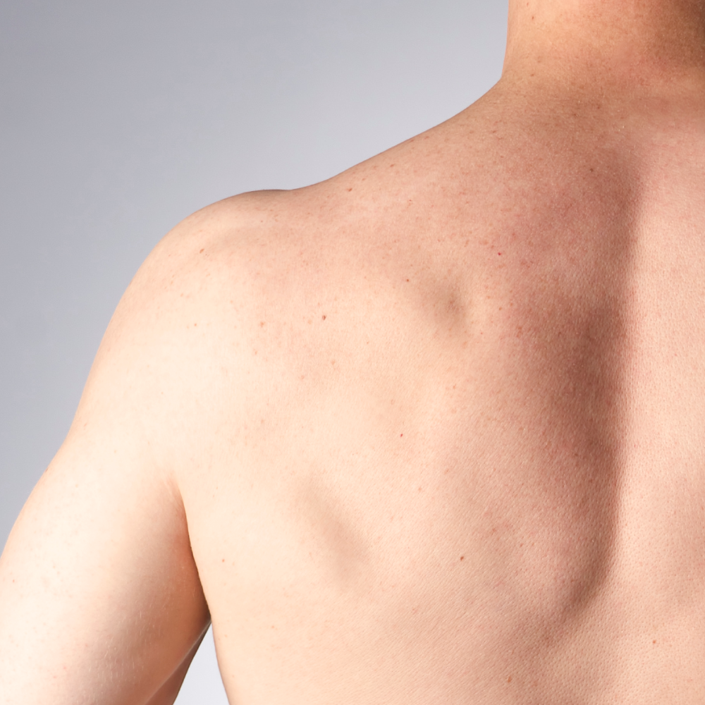 Laser Hair Removal For The Back