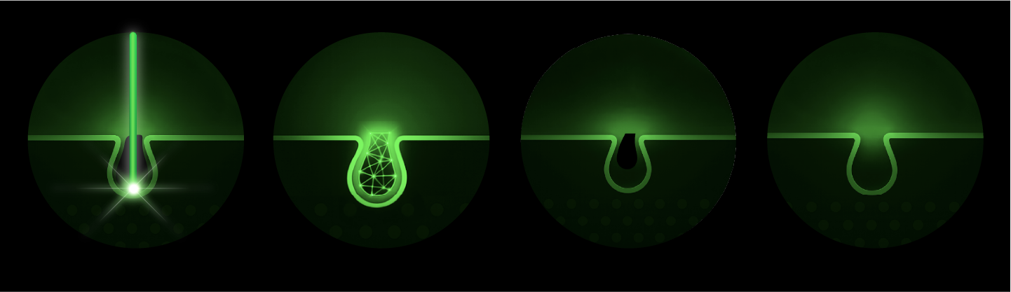 Hair removal process in graphic form