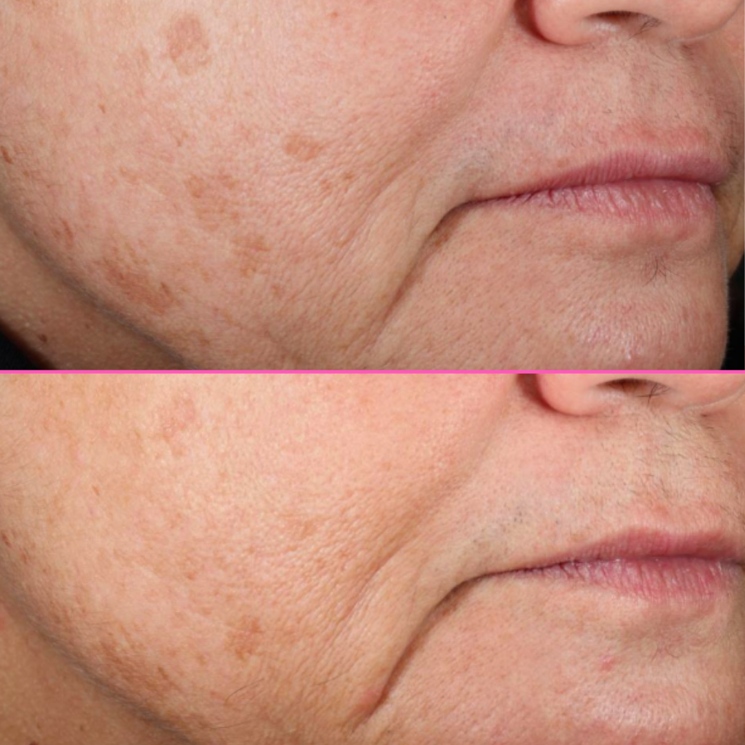 Tria FRX Clinical Study | Improved Skin Texture & Wrinkles – Tria Tria FRX Clinical Study | Improved Skin Texture & Wrinkles – Tria